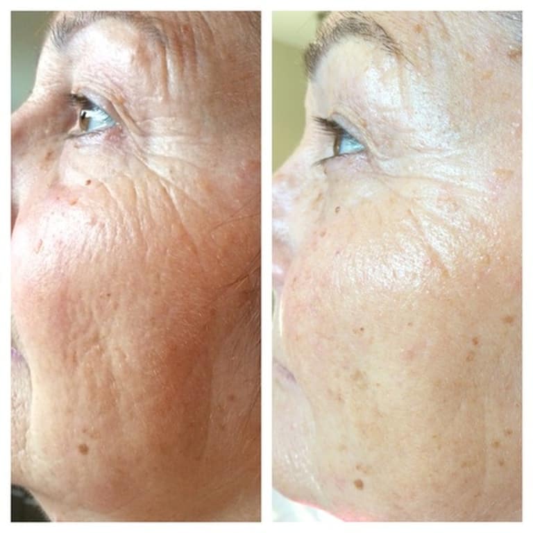 Electro Mesotherapie antiaging ronse