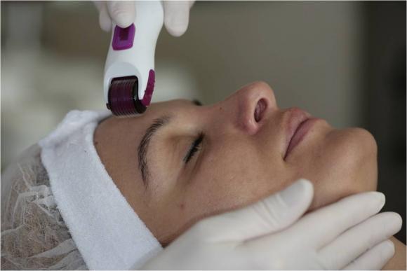 microneedling-huidverzorging